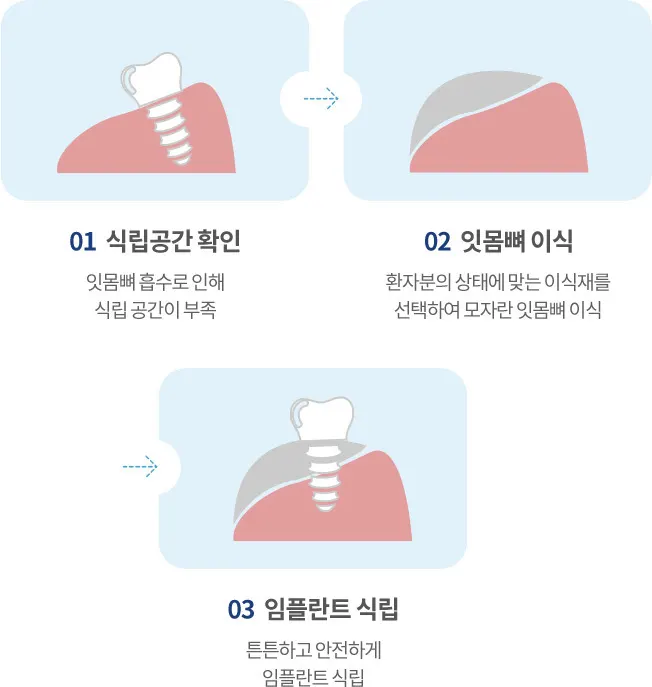 시술과정
