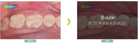  인레이 전후사진_박OO님