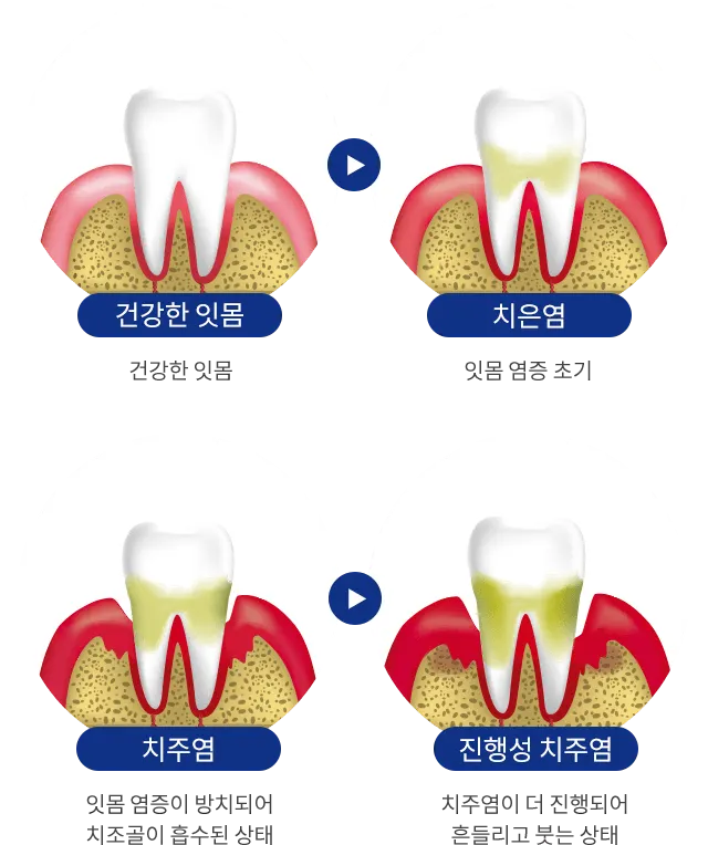 치주질환 진행 단계